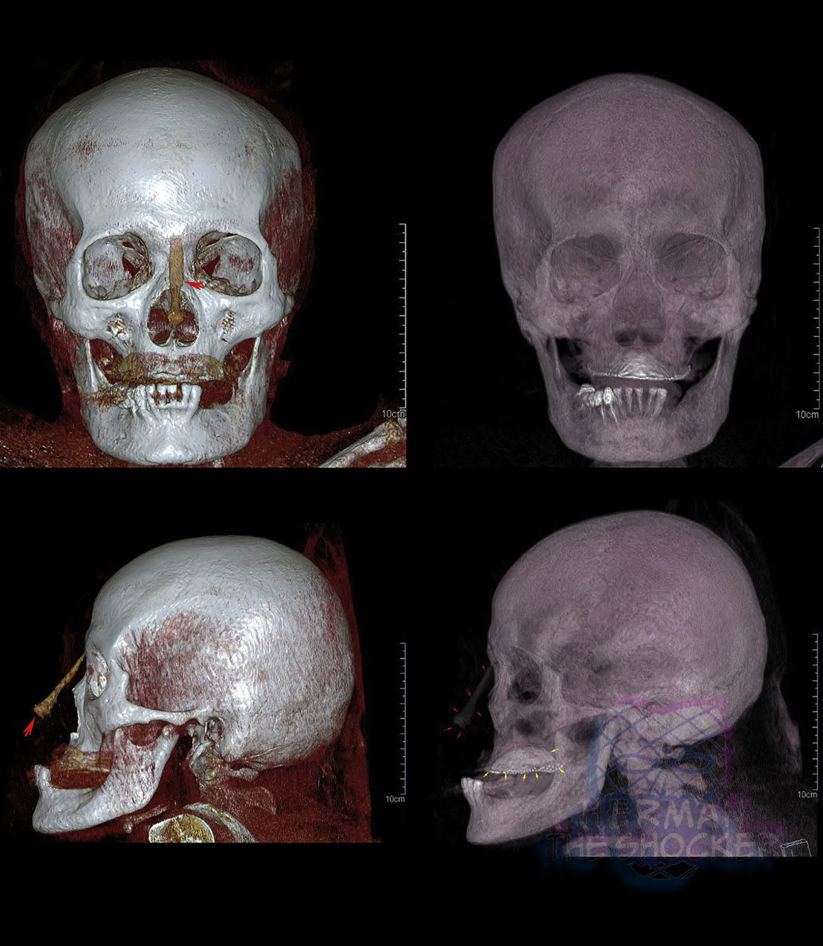 An elderly woman in a state of advanced decomposition
