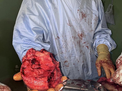 Removal of a mandibulectomy mass