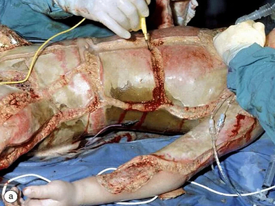 Escharotomy pictures after severe burns