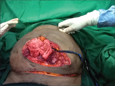 Giant pedunculated incisional hernia