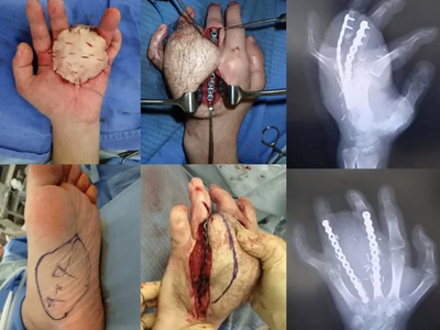 Reconstruction of hand after punching machine accident