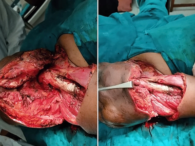 Extraskeletal Ewing sarcoma