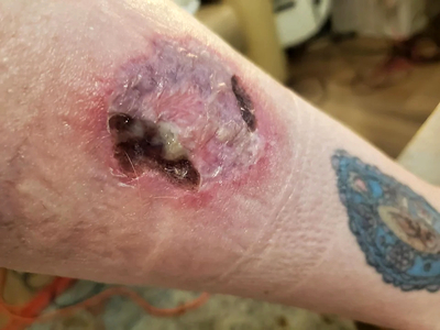 HotHands Burn-Day 1 to Week 5