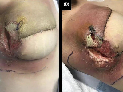 Pyoderma Gangrenosum After Breast Reduction