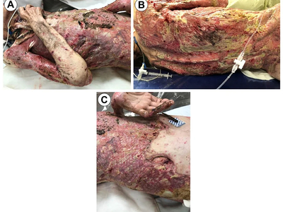 68-year-old male burned over 46% total body surface area