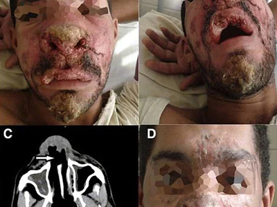 Mucocutaneous Leishmaniasis