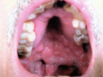 Mucocutaneous Leishmaniasis