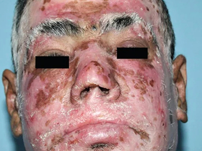 Mucocutaneous Leishmaniasis