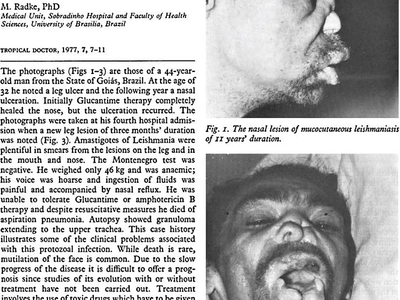 Mucocutaneous Leishmaniasis