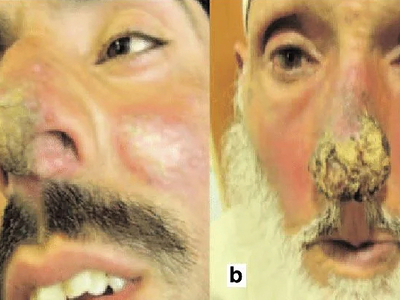 Mucocutaneous Leishmaniasis