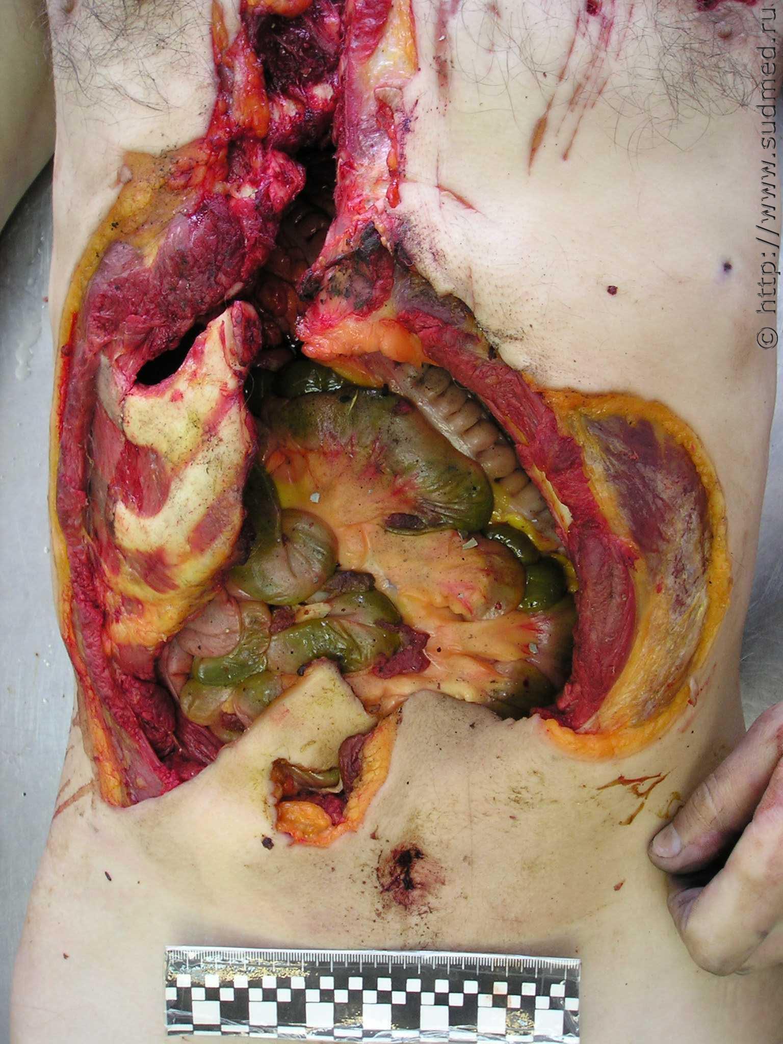 SICKENING: The Russian Cannibal's Leftovers