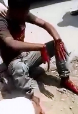 Tendons are the Only Thing Holding this Man's Hand On his Arm 