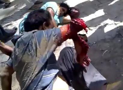 This might be THE Most Fucked Up Arm ive Seen in Gore in a Long Long Time (Wait for It) 