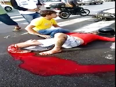 Bottom Leg Ripped and Turned the Opposite Way in Motorcycle Accident 