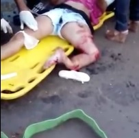 Womans Leg Snapped in Two Locations in Total Agony