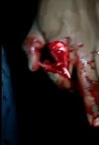 Finger Dangling after Machete blow