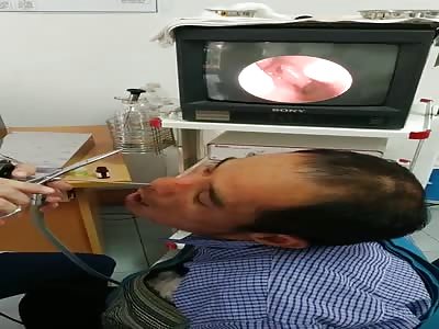 DOCTOR RETRIEVES STRANGE CRIATURE FROM MAN'S NOSE