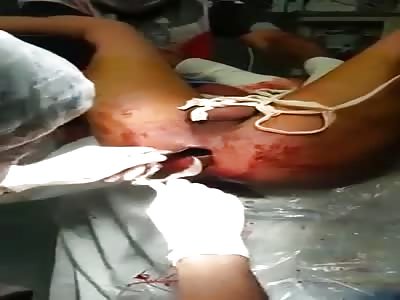 Removing strange homemade object from Man.