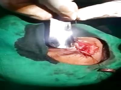 Wooden foreign body removed from eye after 8 months