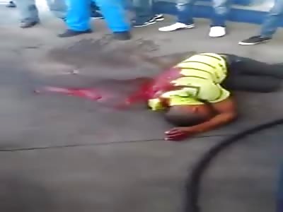  Man suffers an accident and loses the hand that is Bumble