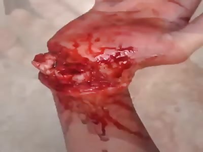 Miraculous healing of bones