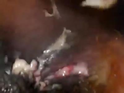 Abscess Inguinal Groin Incision and Drainage