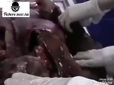 Some forensic medicine