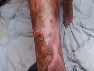 Hansen's disease