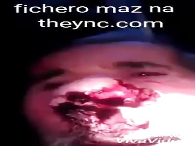 You will rot your nose by consuming poor quality cocaine part 2