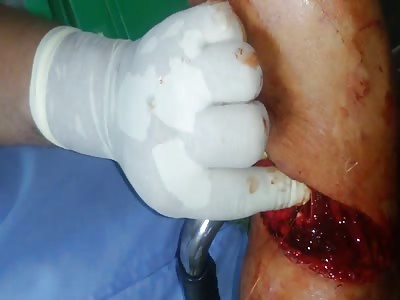 The arm was cut with an electric saw