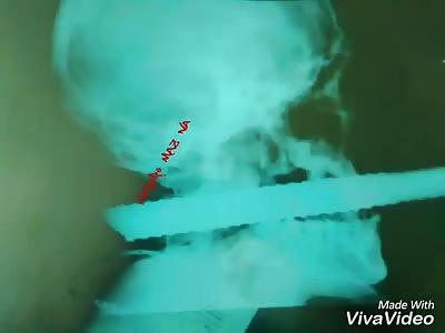 You remove metal rod from the mouth video more photo