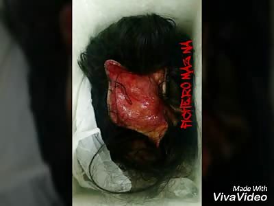 Woman loses scalp