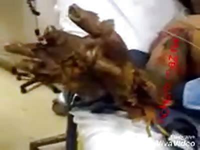 Sequels of masturbation