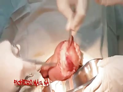 Gangrene of fournier