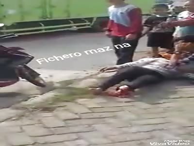 UACCIDENT: accidental loss of foot