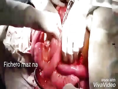 OPERATION TO METER INTESTINES INSIDE OF MAN WHO SUFFERED ACCIDENT