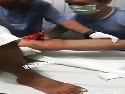 ACCIDENT: man with broken leg