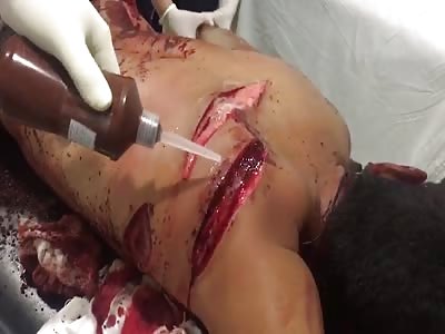 Deep machete wounds treatment