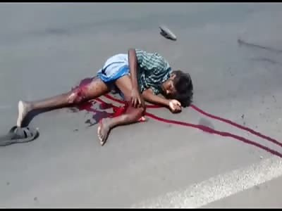 Indian Man with Nasty Leg Break has her Foot Flopping around 