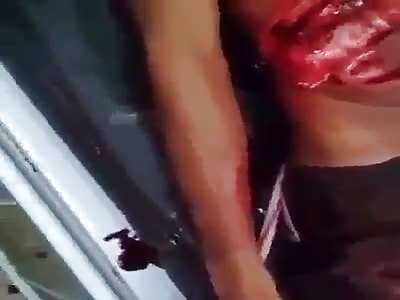 YOUNG WITH INTESTINOS EXPOSED