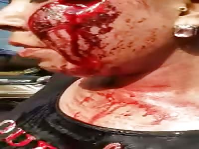 Accident Victim with Severe Arm and Face Injuries 