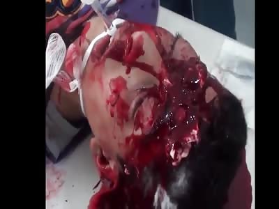 Still alive with crushed head.