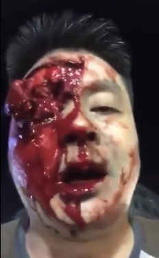 Moron Loses Eye In Fight Over Beer