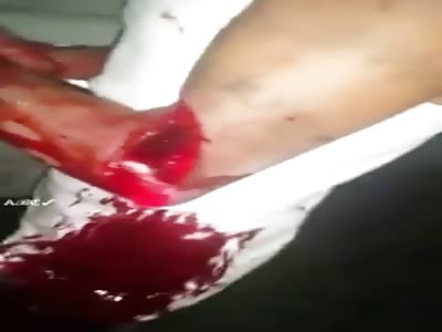 Can You Reattach an Arm?