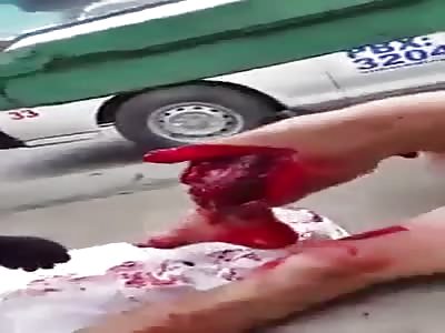 Man with his leg smashed in accident