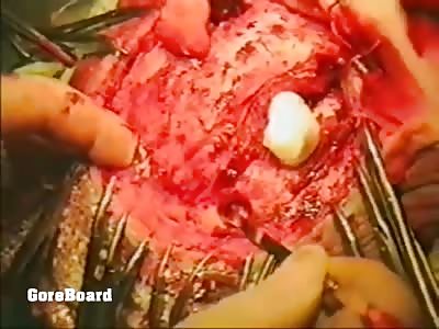 Craniotomy: