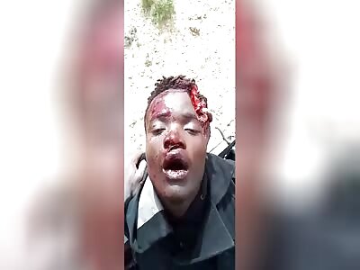 African migrant with bullet wound in the skull after getting shot