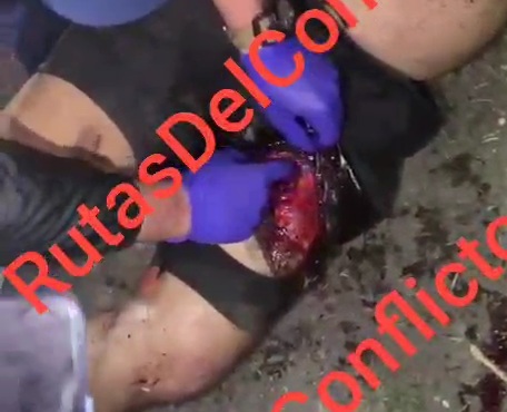 Horrific deadly leg injury after motorcycle accident 