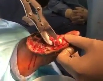 Diabetic patient has part of foot removed due to necrosis 