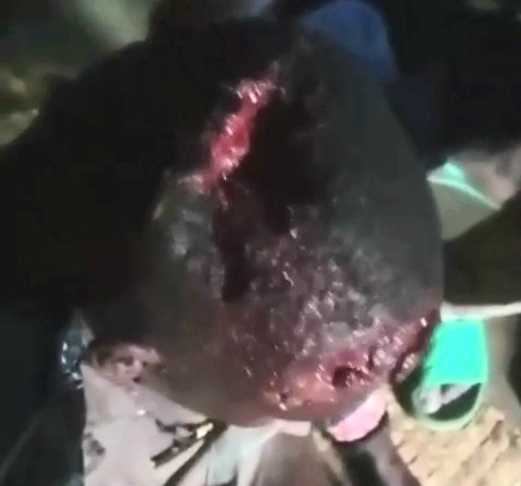 Head cracked after machete attack in Nigeria 